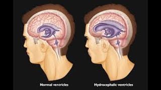 Management of hydrocephalus [upl. by Fillander]