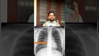 Xray chest expossure ytshorts shortvideo shortfeed [upl. by Tizes]