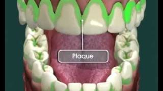 Tooth Decay  How it Happens and How to Avoid it [upl. by Yreneh]