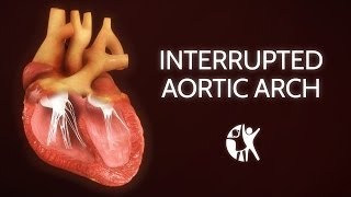 Interrupted Aortic Arch − Ventricular Septic Defect [upl. by Vivie]