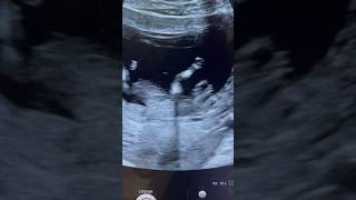 Holoprosencephaly Fetal NT anomaly scan ARDMS Sonography [upl. by Notaes]