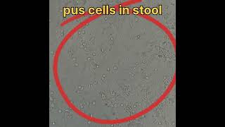 pus cells in stool under microscope [upl. by Irdua]