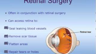 Vitrectomy [upl. by Adnohsal]