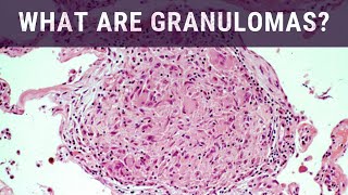 What are Granulomas  Pathology mini tutorial [upl. by Batista]