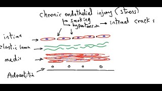 Systemic pathology 10  CVS  atherosclerosis  DRSAMEH GHAZY [upl. by Heng]