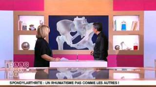 Présentation de la Spondylarthrite Ankylosante [upl. by Sidell]