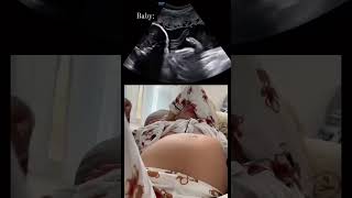 Ultrasound scan In Pregnancy [upl. by Woermer343]