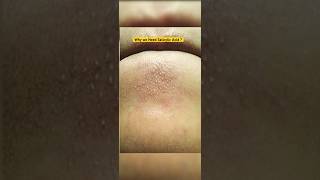 Unsponsored 2 salicylic acid3 Niacinamide serum Reviewdeconstructshotrsskincare viralshorts [upl. by Jobey]