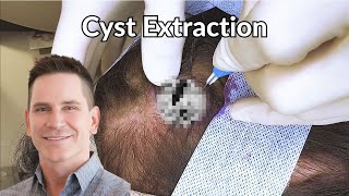 Pearl Shaped Cyst Excavated from Scalp  CONTOUR DERMATOLOGY [upl. by Antin]