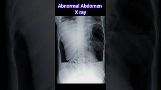 Abnormal Abdomen X ray [upl. by Ryder]