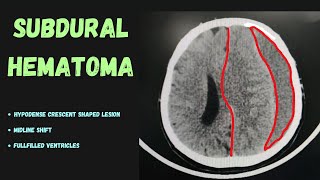 Severe Head Trauma in CT scan Before and After surgery  Subdural Hematoma [upl. by Ahidam]