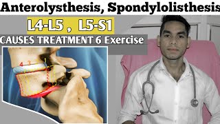 Anterolisthesis spondylolisthesis L5s1 spondylolisthesis Treatment Exercise Low back pain [upl. by Bonis142]