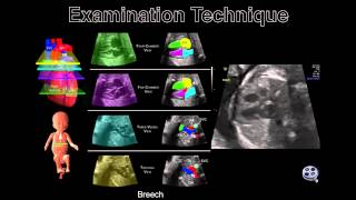 The Fetal HeartThe Transverse Sweep [upl. by Ynaffi]