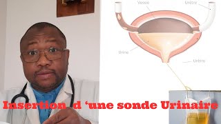 Comment installer une sonde urinaire en 3 etapes simples [upl. by Yleme914]