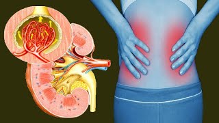 Nephritis Causes And Treatment [upl. by Trovillion]