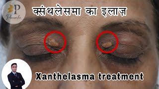 Xanthelasma Surgery in Delhi  Xanthelasma Treatment  Xanthelasma Removal  xanthelasma [upl. by Aem]