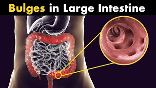 What is diverticulitis  symptoms Causes and treatment [upl. by Arata]