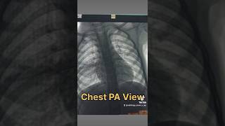 Xray Chest Ap radiologycareer duet radiologist medicalimaging doctor radiology medicaltest [upl. by Alby]