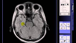 BRAIN MRI Multiple lacunar infarcts [upl. by Eelydnarb]