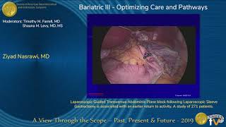 Laparoscopic Guided Transversus Abdominis Plane Block [upl. by Heber]