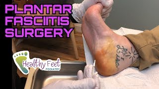 How To Cure Plantar Fasciitis With Surgery by Podiatrist Dr Leo Krawetz Plantar Fasciitis Cure [upl. by Ykcub693]