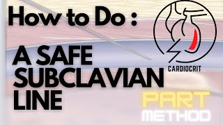 How to do a SAFE SUBCLAVIAN LINE  The PART Method [upl. by Dnomde]