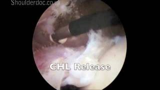 Cuff Releases  anterior and CHL  viewing from posterior and working from lateral  labelsmov [upl. by Fabian]