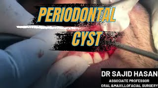 ENUCLEATION OF LATERAL PERIODONTAL CYST [upl. by Naid660]