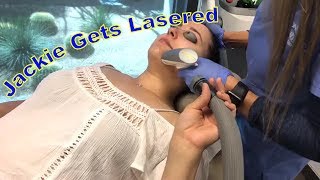 Jackie Gets Lasered Sublative Laser Treatment for Acne Scars [upl. by Ynohtona]