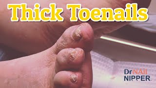 How to cut thick toenails Dr Nail Nipper is trimming Thick Toenails and Calluses [upl. by Jammal]