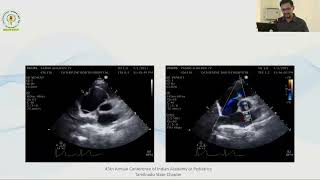 Approach to Congenital Cyanotic Heart Disease in neonatal period  Dr M Venkatesh [upl. by Meagan919]