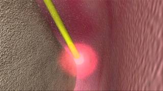 Laser Periodontal Therapy  WPT™ Animation [upl. by Rehtaef542]