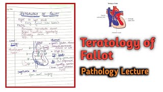 Tetralogy of fallot  Cardiology medical [upl. by Edwyna58]