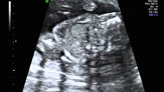 Tetralogy of Fallot with absent pulmonary valve syndrome [upl. by Naeerb]