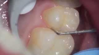 Whats the gary shadow on my tooth Premolar Series 2 of 3 [upl. by Tobey29]