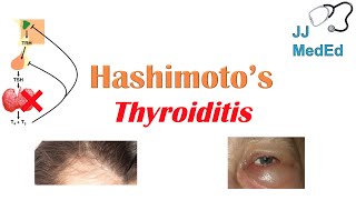 Hashimoto’s thyroiditis What Is It Whos At Risk and What You NEED to Know [upl. by Runck364]