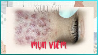 Big Cystic Acne Blackheads Extraction Blackheads amp Milia Whiteheads Removal Pimple Popping [upl. by Carver664]