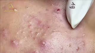 Loan Nguyen Acne Treatment 1737h [upl. by Aillicirp]