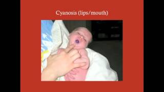 Surgery of Cyanotic CHDs  CRASH Medical Review Series [upl. by Alec761]