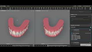 Whether to remove a mandibular lower incisor or leave upper spacing with broader arches [upl. by Notlit376]