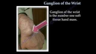 Ganglion Cyst Of The Wrist  Everything You Need To Know  Dr Nabil Ebraheim [upl. by Johnathon]