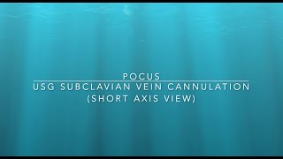 USG guided subclavian CVP line insertion short axis view Part 2 [upl. by Etiuqal]