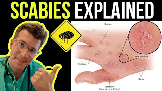 Doctor explains SCABIES skin rash including SYMPTOMS PHOTOS OF SKIN TREATMENT amp more [upl. by Hidie62]