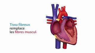 Rétrécissement mitral [upl. by Ydarg]