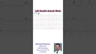 Left Bundle Branch Block [upl. by Norad953]