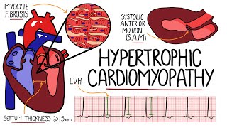 Hypertrophic Cardiomyopathy Made Easy  Includes Hypertrophic Obstructive Cardiomyopathy amp SAM [upl. by Attah262]