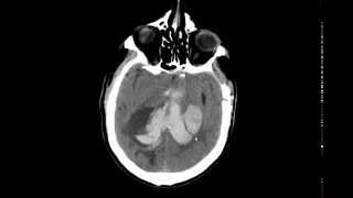 large IntraCerebral Hemorrhage [upl. by Elidad456]