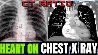 CHEST X RAYHEARTREFLECTION 1C9 [upl. by Mayworm]