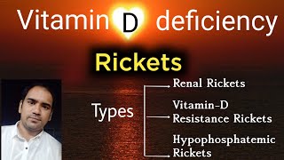 VitaminD deficiency  Rickets and types of rickets RenalVitamin D resistance amp Hypophospatemic [upl. by Udell]