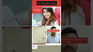 Skin Tag Removal Success  Happy Customers Journey with Dr Deepika Raval  Dr Deepika Skin Care [upl. by Aseretairam]